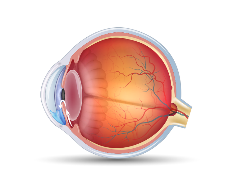 illustration to show how the eye is affected by fluid build up