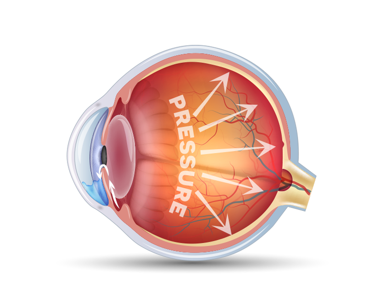 illustration to show how the eye is affected by increased pressure