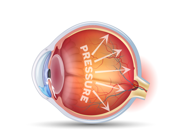 Illustration to show how the eye is damaged over time